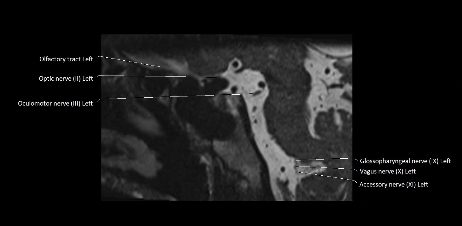 Cranial nerve sagittal anatomy MRI 3T image 26.webp